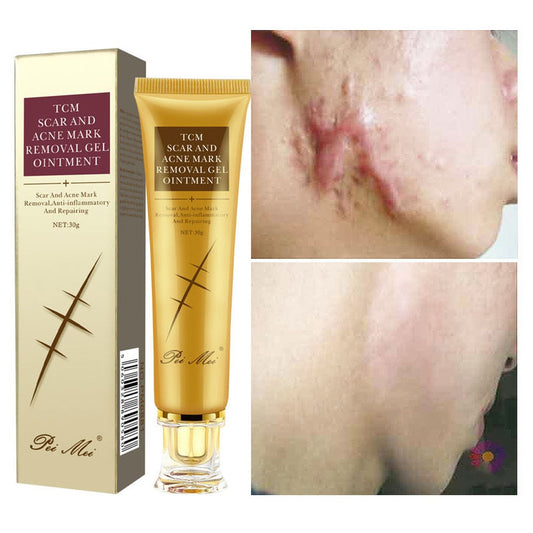 Acne Scar Removal Cream